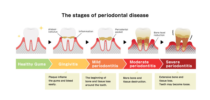 Recognising the signs of gum disease