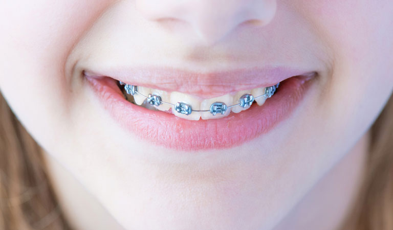 types-of-braces