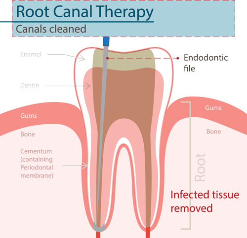 Root canal therapy